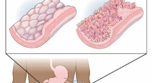 Celiac Disease: Symptoms & How It’s Treated