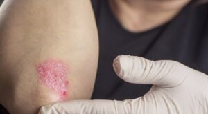 Study sheds light on potential mechanism by which psoriasis increases cardiovascular risk